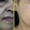 ⁦برنامج علاج التصبغات و الكلف⁩ - الصورة ⁦3⁩