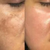 ⁦برنامج علاج التصبغات و الكلف⁩ - الصورة ⁦2⁩