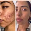⁦برنامج علاج الحبوب و اثارها والندبات⁩ - الصورة ⁦3⁩