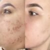 ⁦برنامج علاج الحبوب و اثارها والندبات⁩ - الصورة ⁦5⁩